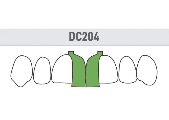 Diastema Matrices - Extreme Diastema Closure - Incisor Mesial  Bioclear Original Anterior Matrix  - Τεχνητά Τοιχώματα Προσθίων Δοντιών 