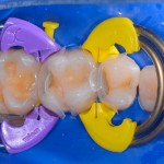 Twin Ring Premolar Biofit HD Matrix - Τεχνητά Τοιχώματα Οπισθίων 