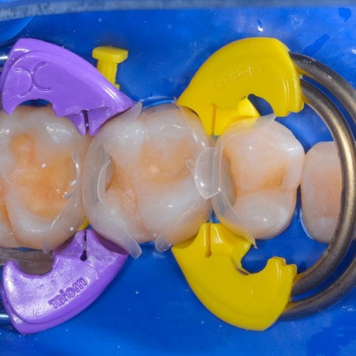 Twin Ring Premolar