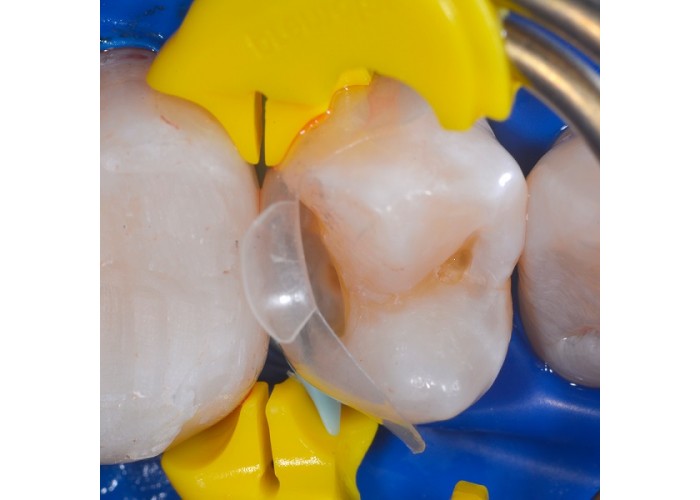 Twin Ring Premolar Biofit HD Matrix - Τεχνητά Τοιχώματα Οπισθίων 